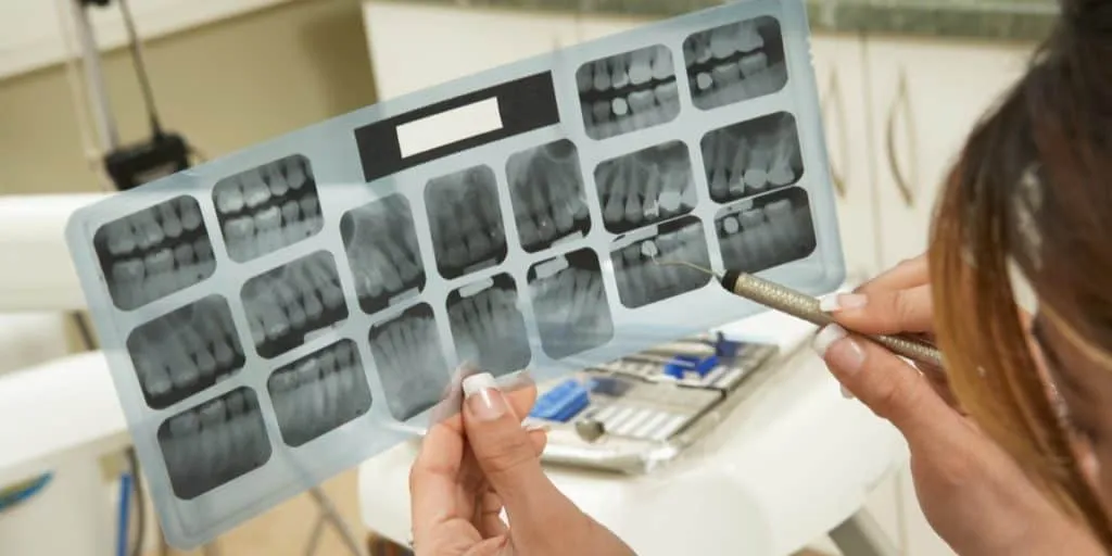 Dentist using dental scaler to point a section on dental X-ray result.