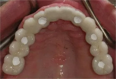 Smile gallery. View from under a patient's upper teeth showing implant placement.