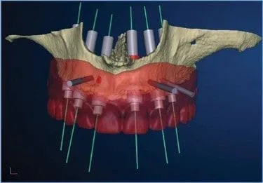 Smile gallery. Digital image of a dental plan for teeth with compromised roots.