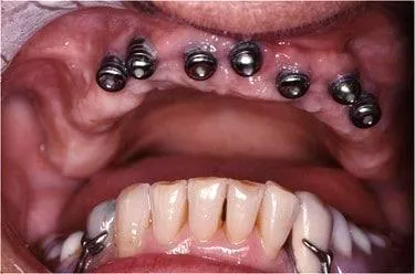 Smile gallery. Image of dental implant placement to the upper gums