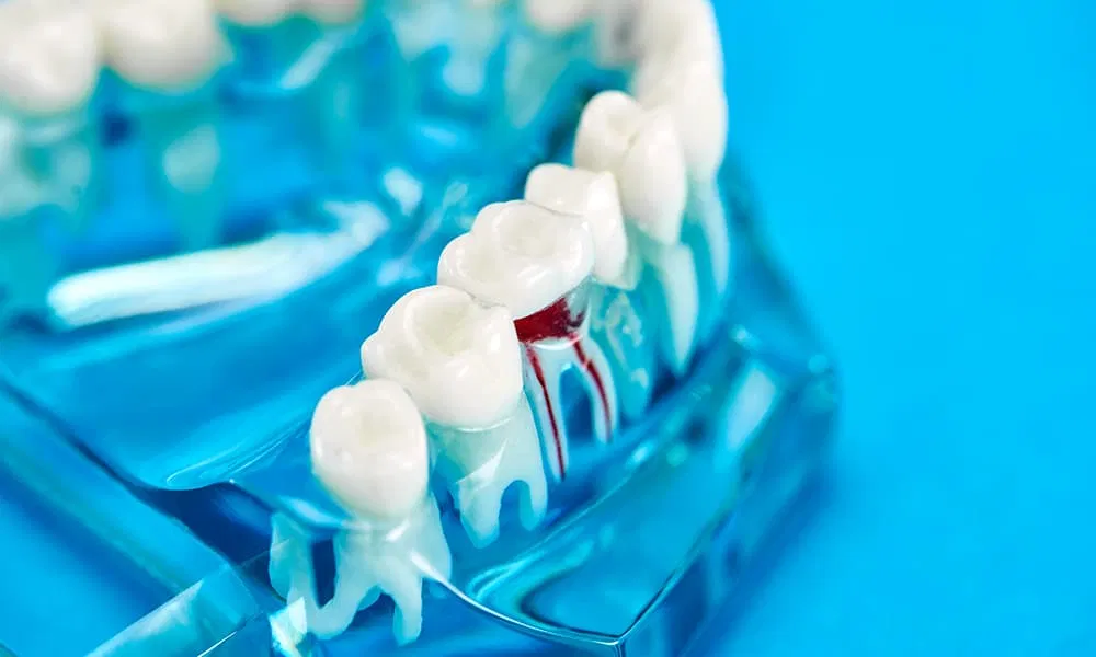 Dental model showing diseased tooth candidate for root amputation.