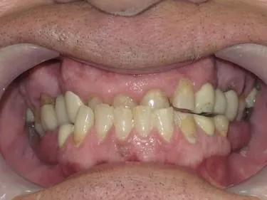 Smile gallery. Image of unattended worn down teeth resulting to severe bite loss.